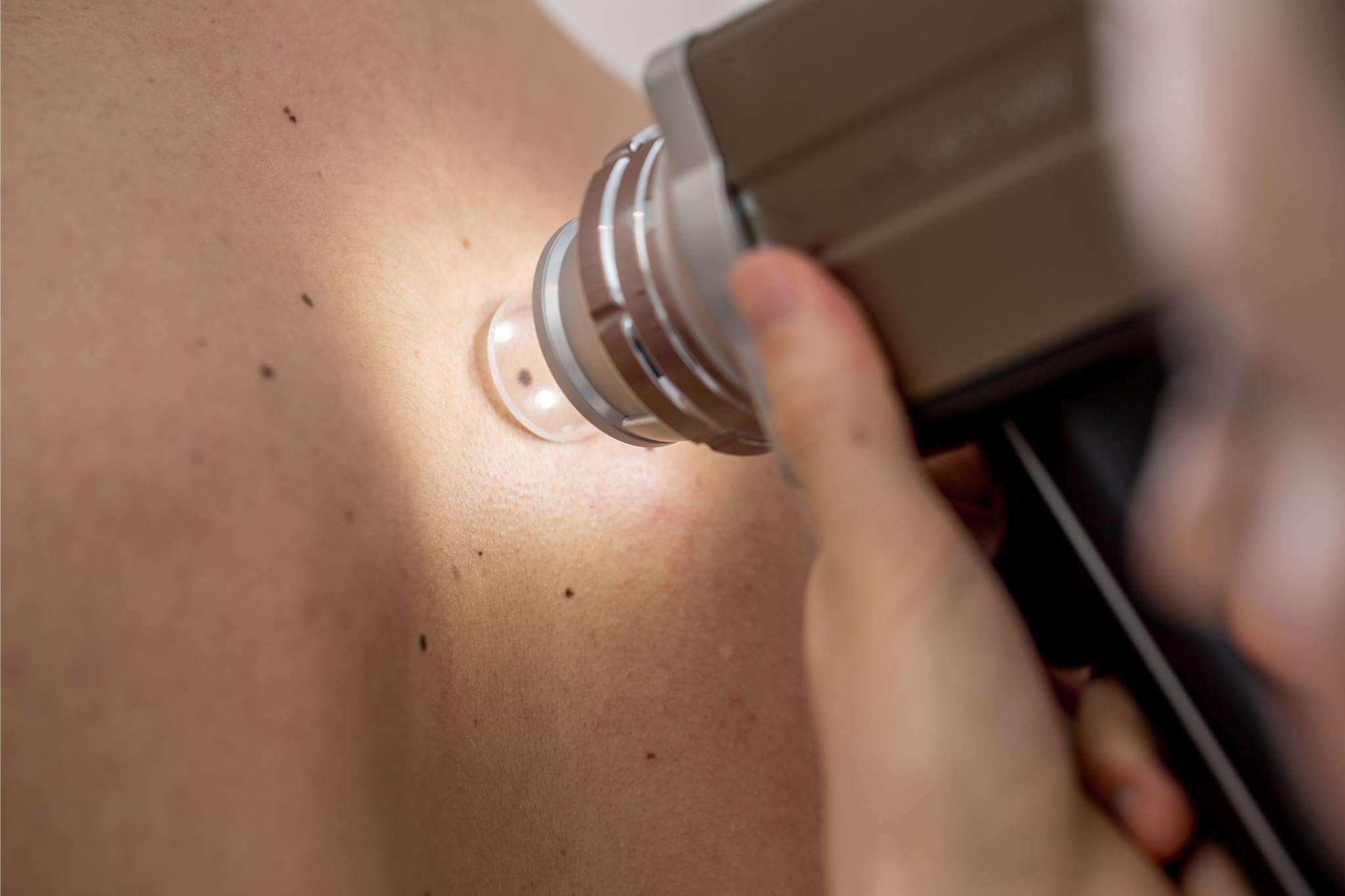 long-term-mole-monitoring-dermatology