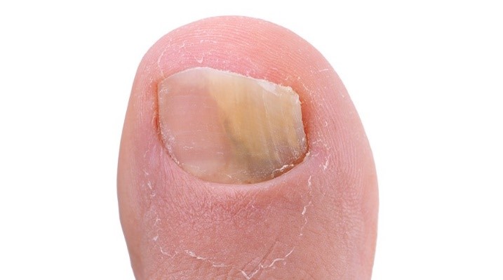 Onychomycosis Fungal Infection Of The Nail Stock Photo - Download Image Now  - Alternative Therapy, Beauty Product, Body Care - iStock